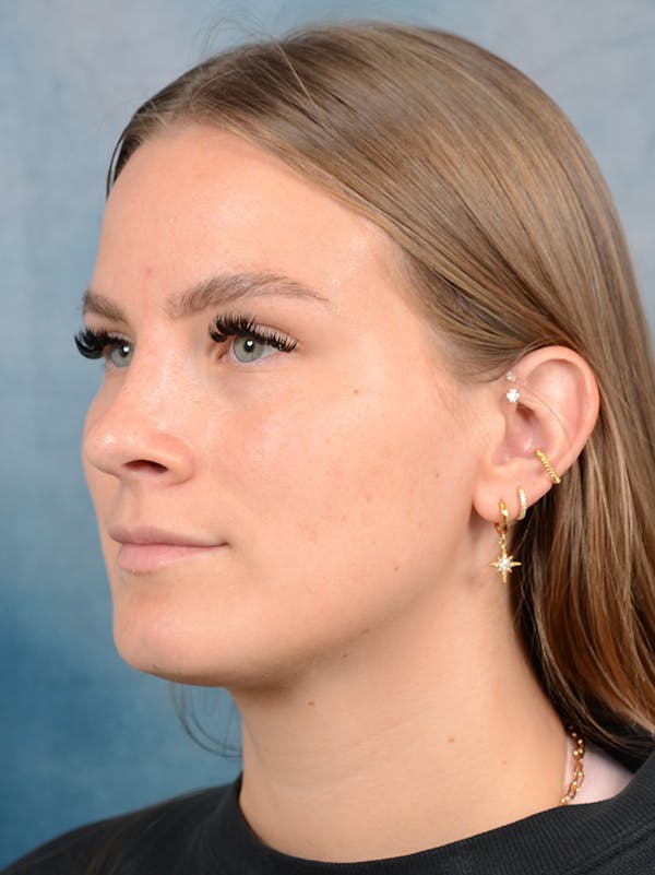Rhinoplasty Before & After Gallery - Patient 67326347 - Image 4
