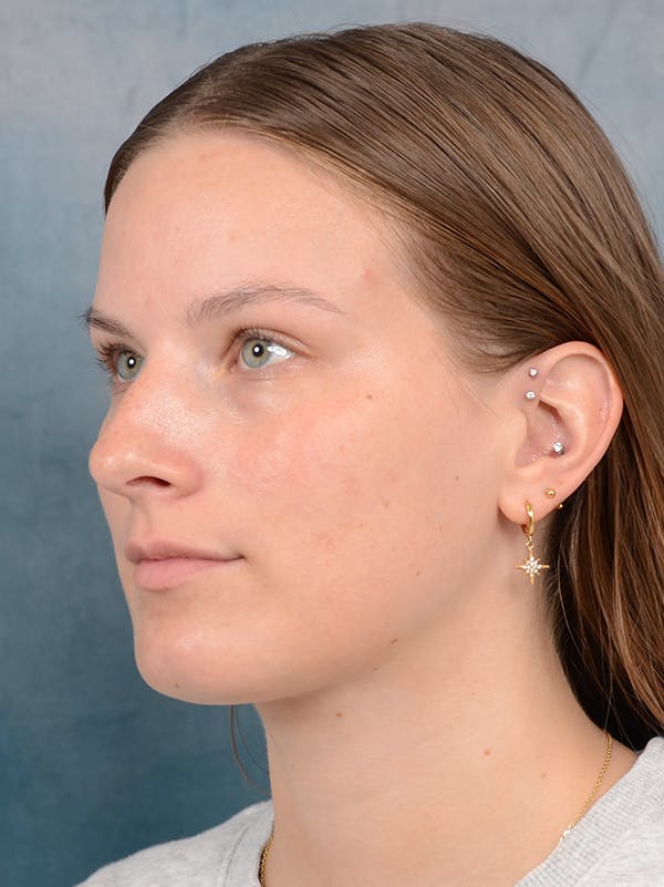 Rhinoplasty Before & After Gallery - Patient 67326347 - Image 3