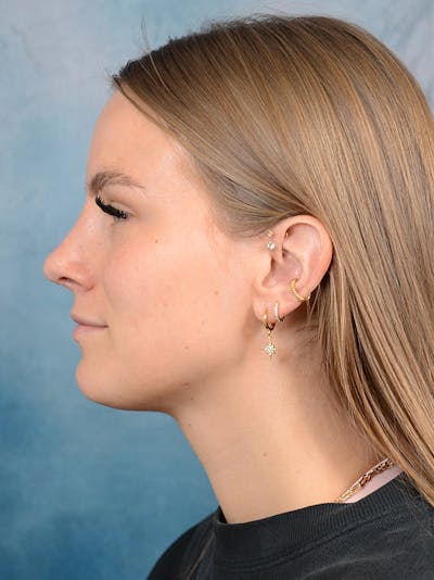 Rhinoplasty Before & After Gallery - Patient 67326347 - Image 2
