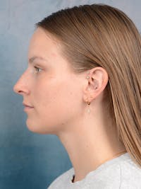 Rhinoplasty Before & After Gallery - Patient 67326347 - Image 1