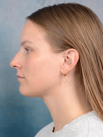 Rhinoplasty Before & After Gallery - Patient 67326347 - Image 1