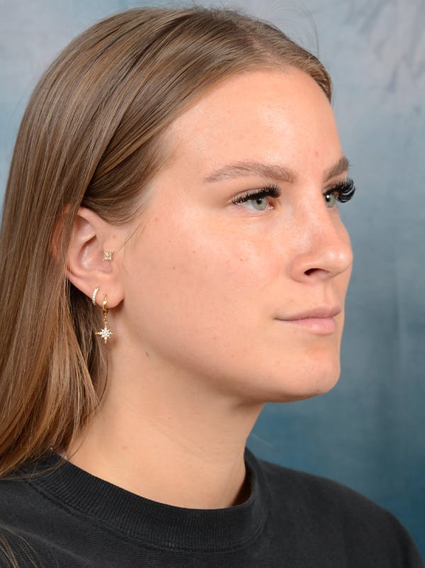 Rhinoplasty Before & After Gallery - Patient 67326347 - Image 8