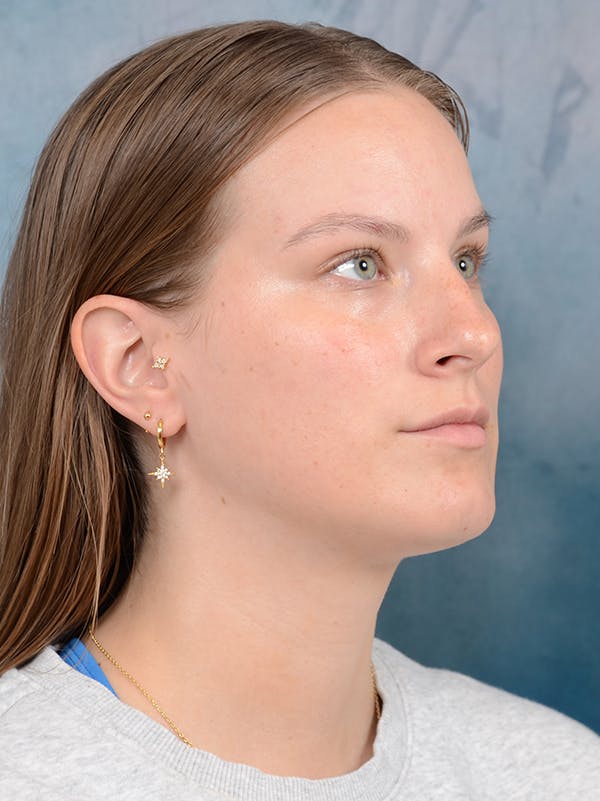 Rhinoplasty Before & After Gallery - Patient 67326347 - Image 7