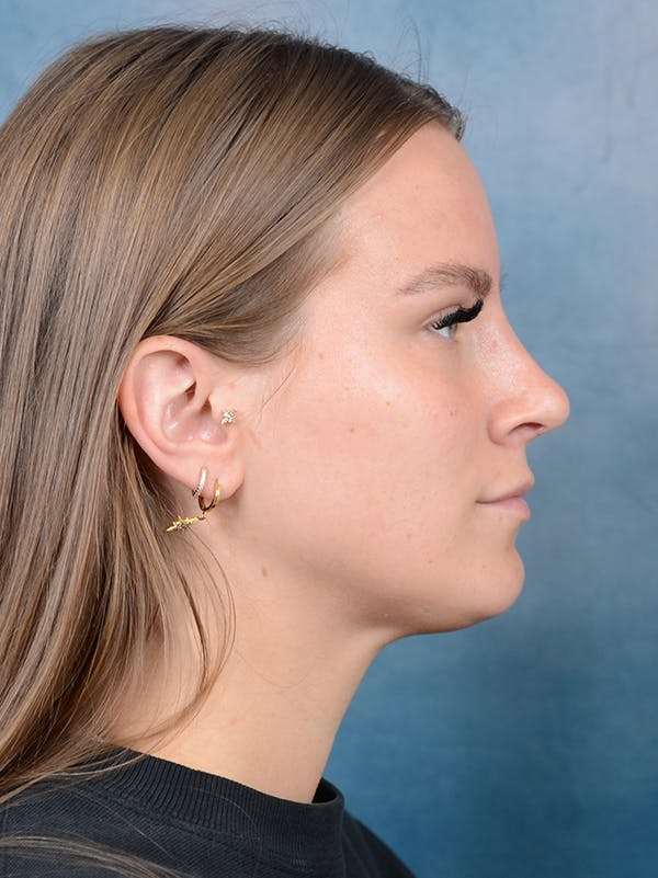 Rhinoplasty Before & After Gallery - Patient 67326347 - Image 10