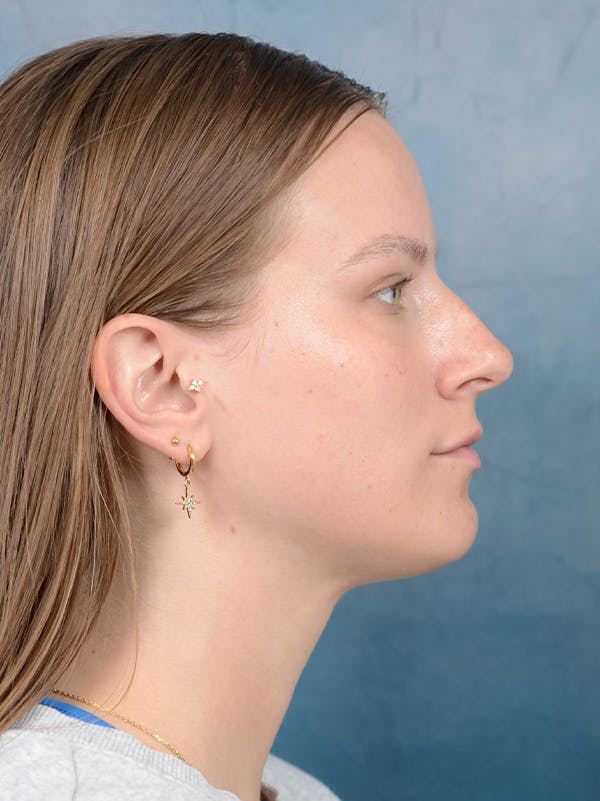 Rhinoplasty Before & After Gallery - Patient 67326347 - Image 9