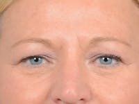 Brow Lift Before & After Gallery - Patient 72465077 - Image 1