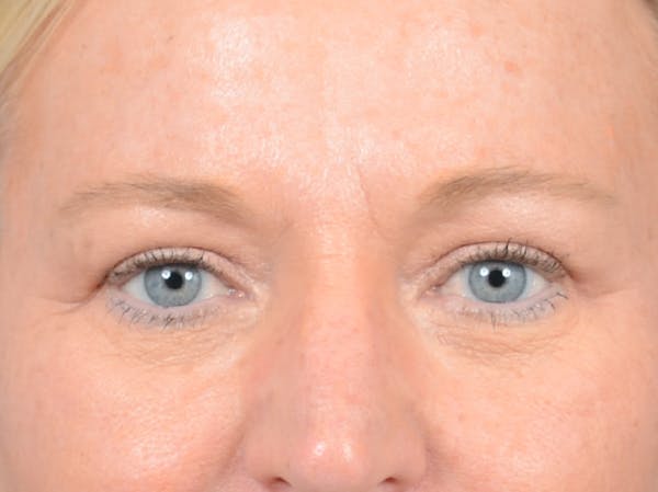 Brow Lift Before & After Gallery - Patient 72465077 - Image 2