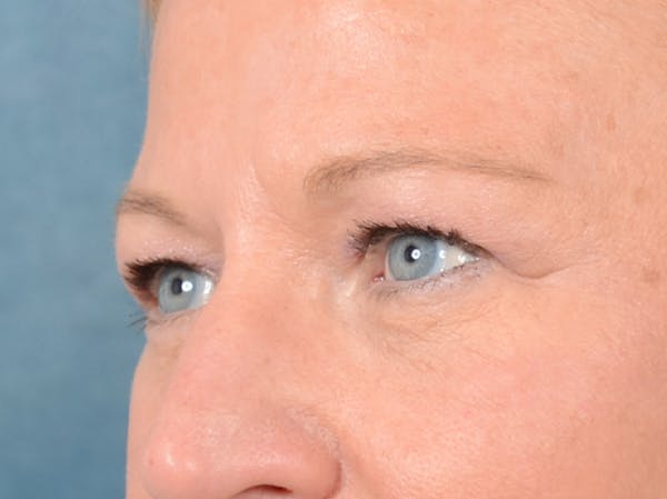 Brow Lift Before & After Gallery - Patient 72465077 - Image 3