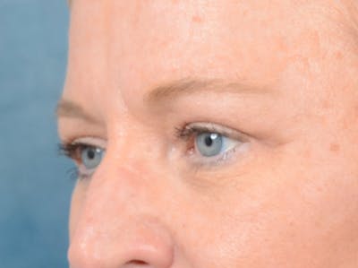 Eyelid Lift Before & After Gallery - Patient 72465017 - Image 4