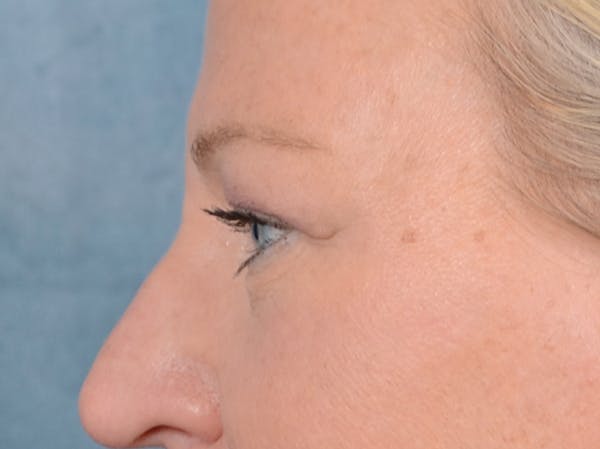 Brow Lift Before & After Gallery - Patient 72465077 - Image 5