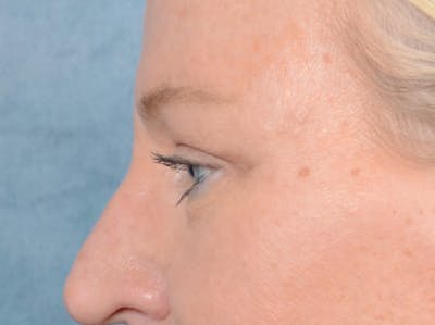 Brow Lift Before & After Gallery - Patient 72465077 - Image 6