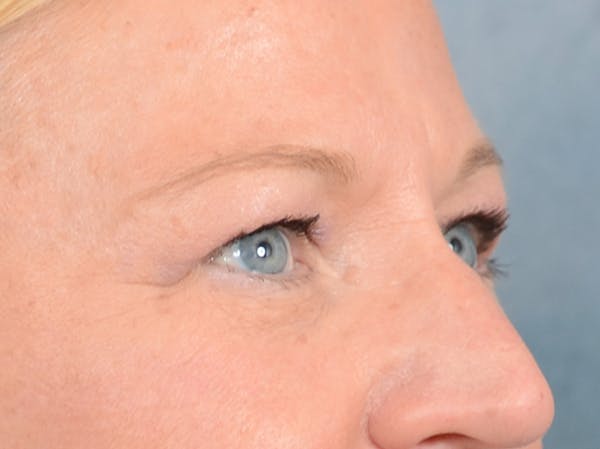 Eyelid Lift Before & After Gallery - Patient 72465017 - Image 7