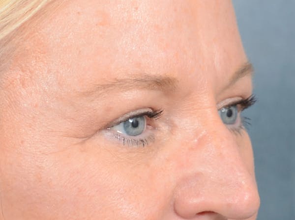 Brow Lift Before & After Gallery - Patient 72465077 - Image 8