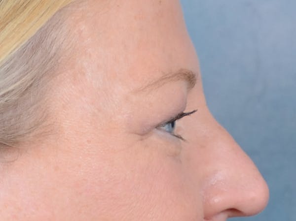 Brow Lift Before & After Gallery - Patient 72465077 - Image 9