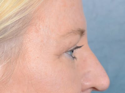 Brow Lift Before & After Gallery - Patient 72465077 - Image 10