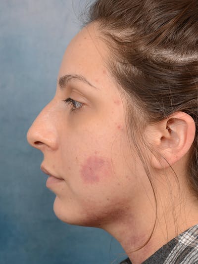 Rhinoplasty Before & After Gallery - Patient 72465179 - Image 1