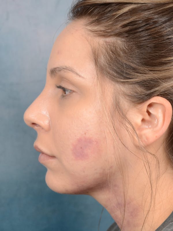 Rhinoplasty Before & After Gallery - Patient 72465179 - Image 2