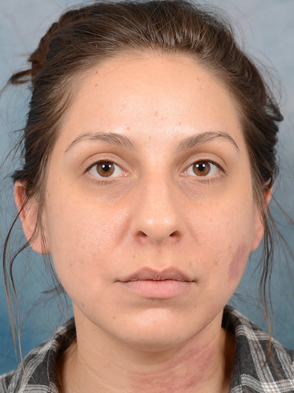 Rhinoplasty Before & After Gallery - Patient 72465179 - Image 3