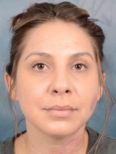 Rhinoplasty Before & After Gallery - Patient 72465179 - Image 4
