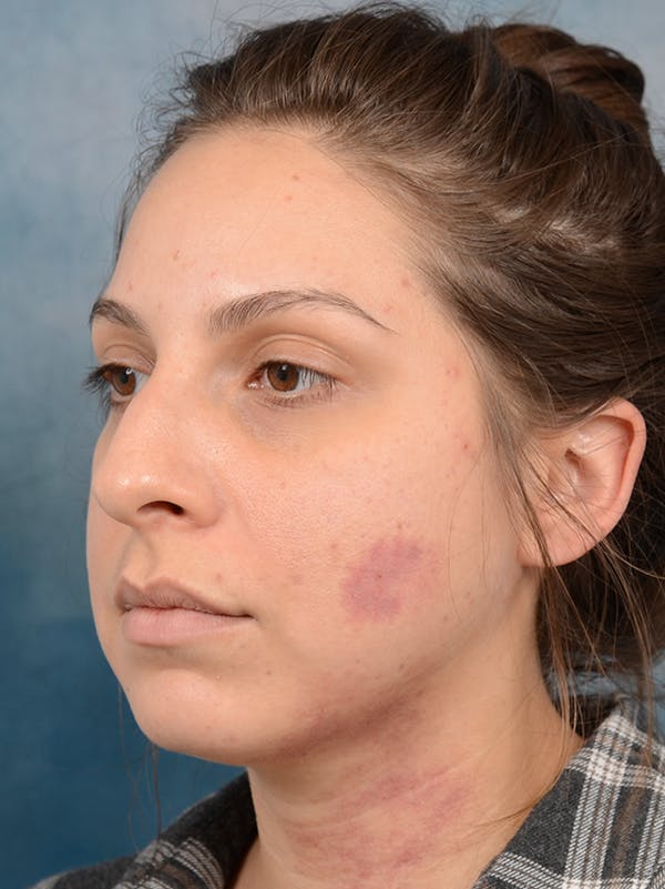 Rhinoplasty Before & After Gallery - Patient 72465179 - Image 5
