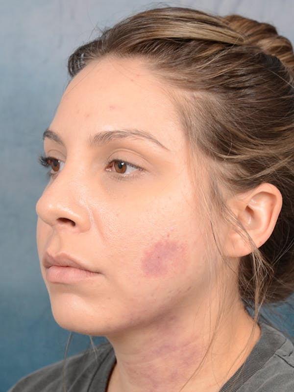 Rhinoplasty Before & After Gallery - Patient 72465179 - Image 6