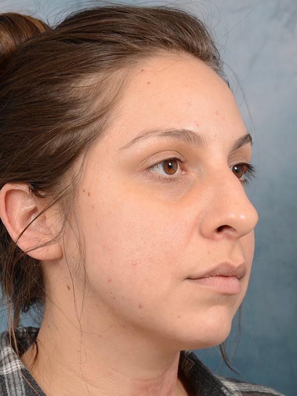 Rhinoplasty Before & After Gallery - Patient 72465179 - Image 7