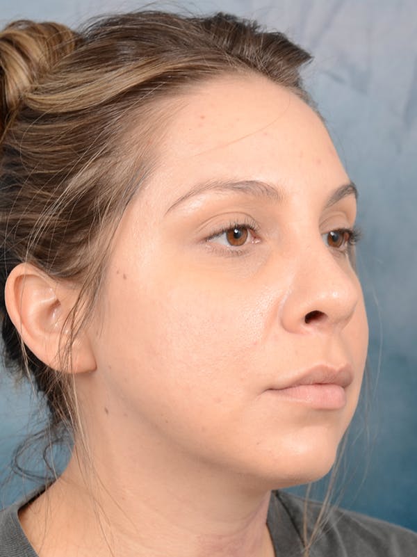 Rhinoplasty Before & After Gallery - Patient 72465179 - Image 8