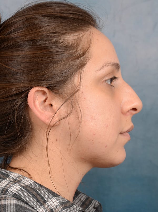 Rhinoplasty Before & After Gallery - Patient 72465179 - Image 9
