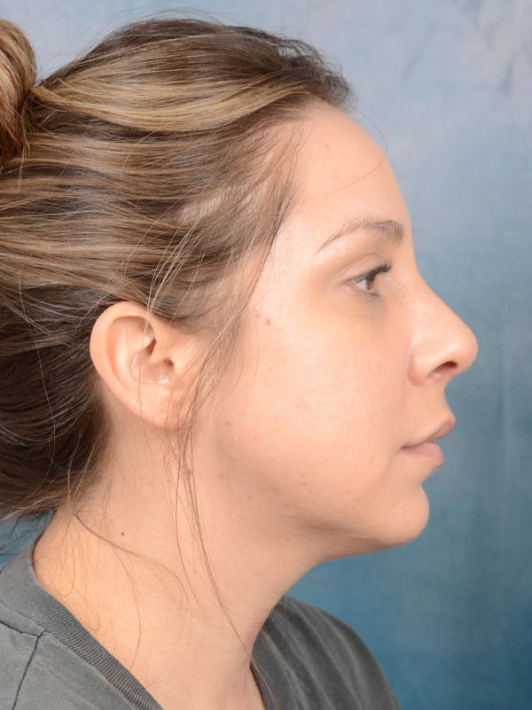 Rhinoplasty Before & After Gallery - Patient 72465179 - Image 10