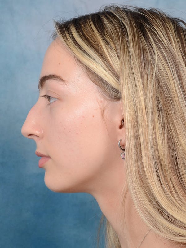 Rhinoplasty Before & After Gallery - Patient 72492247 - Image 1