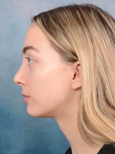 Rhinoplasty Before & After Gallery - Patient 72492247 - Image 2