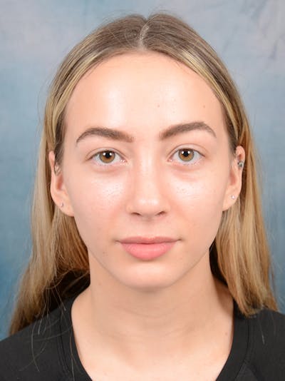 Rhinoplasty Before & After Gallery - Patient 72492247 - Image 4