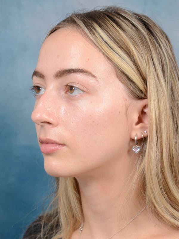 Rhinoplasty Before & After Gallery - Patient 72492247 - Image 5
