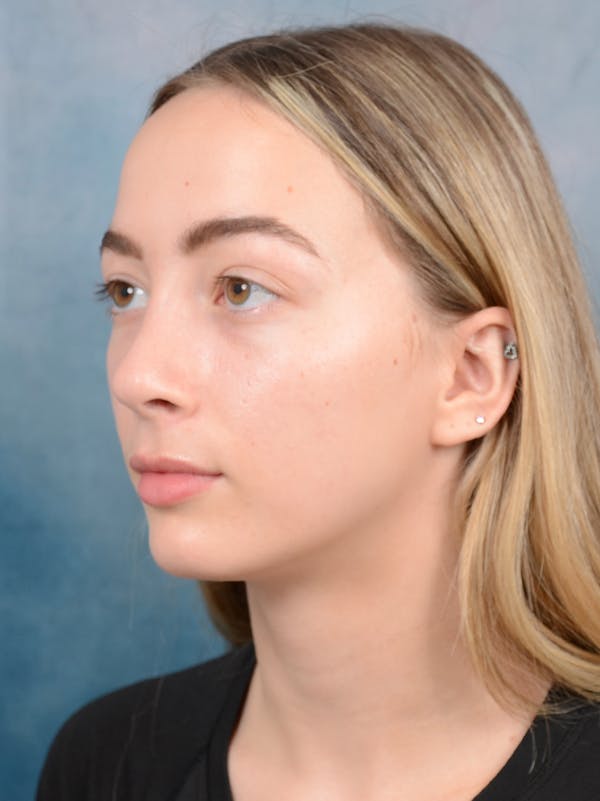 Rhinoplasty Before & After Gallery - Patient 72492247 - Image 6