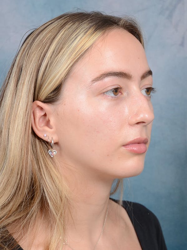 Rhinoplasty Before & After Gallery - Patient 72492247 - Image 7