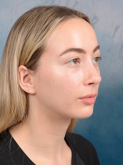 Rhinoplasty Before & After Gallery - Patient 72492247 - Image 8