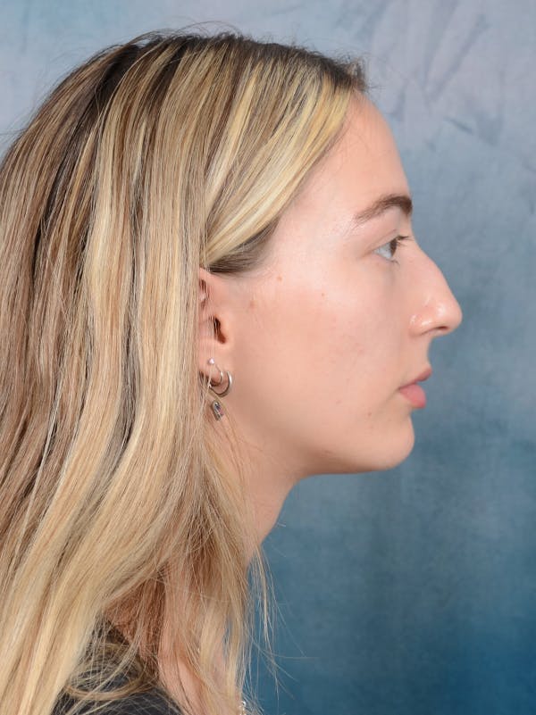 Rhinoplasty Before & After Gallery - Patient 72492247 - Image 9