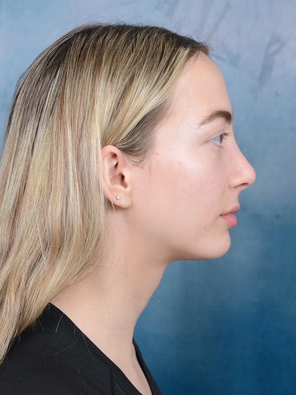 Rhinoplasty Before & After Gallery - Patient 72492247 - Image 10