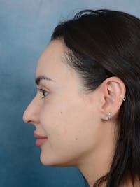 Rhinoplasty Before & After Gallery - Patient 73980637 - Image 1