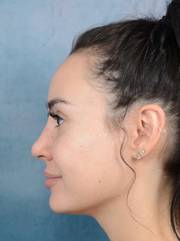 Rhinoplasty Before & After Gallery - Patient 73980637 - Image 2