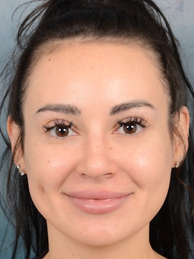 Rhinoplasty Before & After Gallery - Patient 73980637 - Image 4