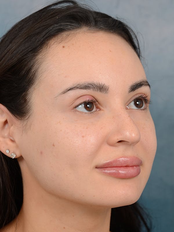 Rhinoplasty Before & After Gallery - Patient 73980637 - Image 7