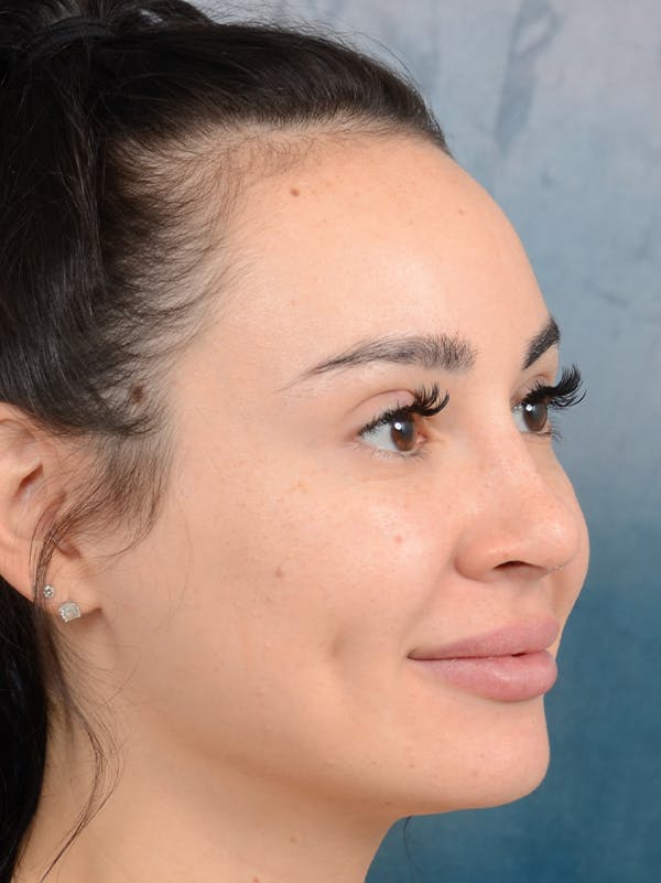 Rhinoplasty Before & After Gallery - Patient 73980637 - Image 8