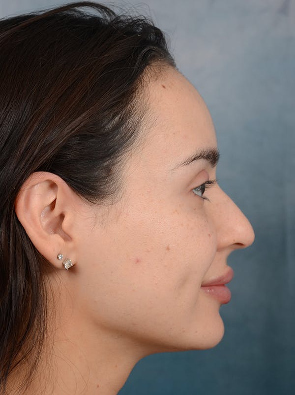 Rhinoplasty Before & After Gallery - Patient 73980637 - Image 9