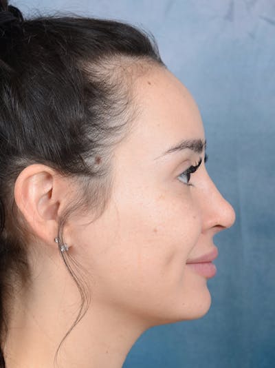 Rhinoplasty Before & After Gallery - Patient 73980637 - Image 10