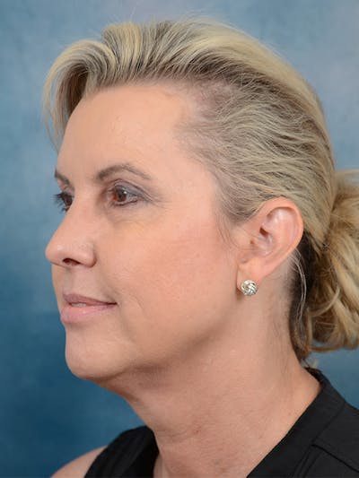 Deep Plane Facelift Before & After Gallery - Patient 81486068 - Image 1