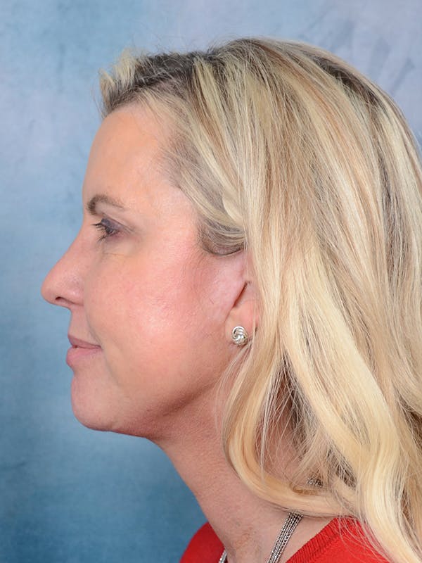 Deep Plane Facelift Before & After Gallery - Patient 81486068 - Image 4