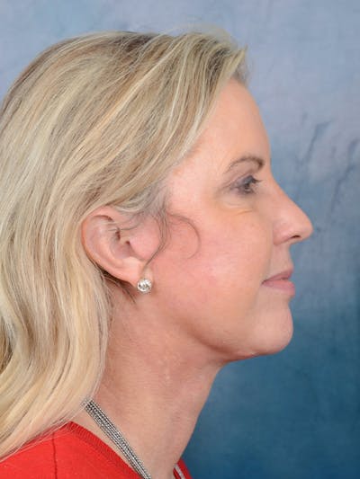 Deep Plane Facelift Before & After Gallery - Patient 81486068 - Image 8