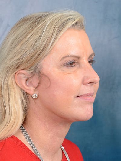 Deep Plane Facelift Before & After Gallery - Patient 81486068 - Image 10