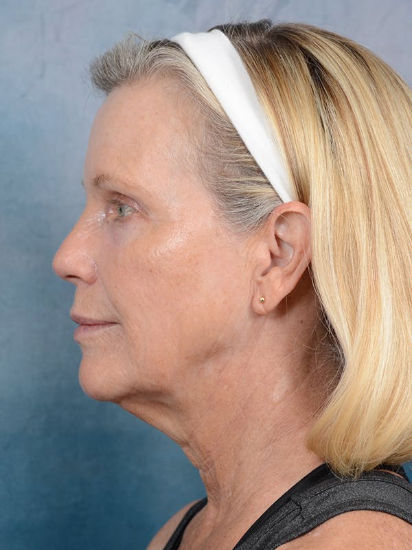 laser resurfacing